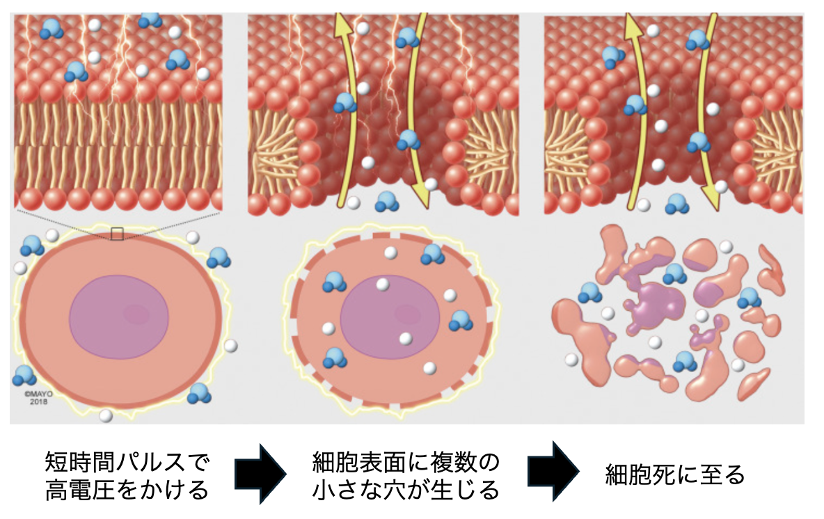 パルスフィールドアブレーションの原理